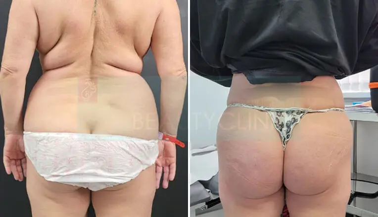 Back Vaser Liposuction Before And After