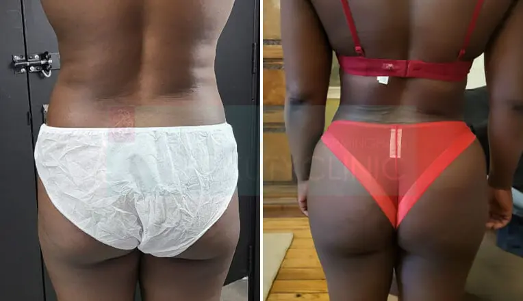 Back Vaser Liposuction Before And After