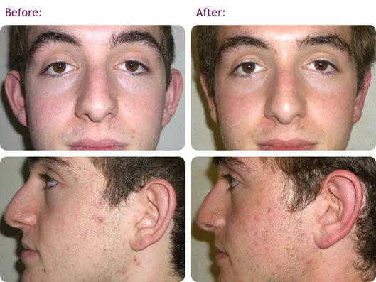 birmingham-ear-lobe-correction-surgery