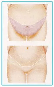 birmingham-tummytuck