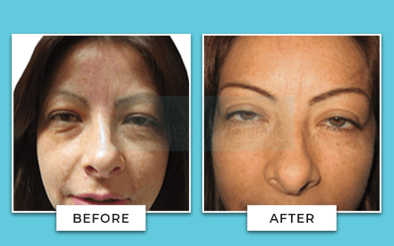 Blepharoplasty Before And After