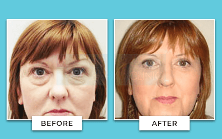 Blepharoplasty Before And After