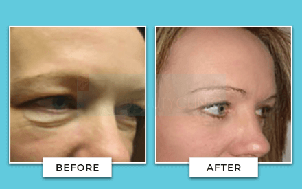 Blepharoplasty Before And After
