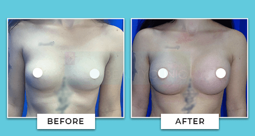 Breast Augmentation Before and After