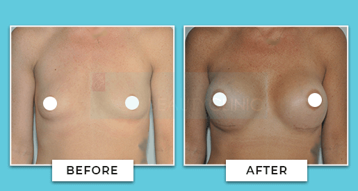 Breast Augmentation Before and After