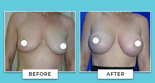 Breast Augmentation Before and After