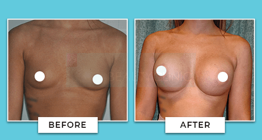 Breast Augmentation Before and After