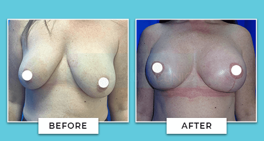 Breast Augmentation Before and After