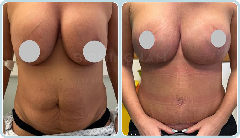 breast augmentation, lift and tummy tuck
