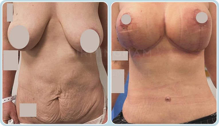 breast lift and tummy tuck