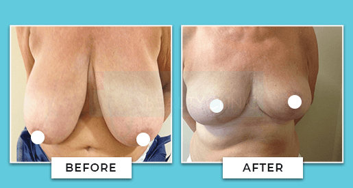 Breast Reduction Before And After