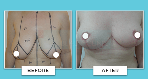 Breast Reduction Before And After