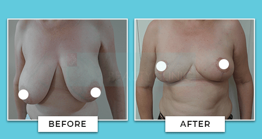 Breast Reduction Before And After