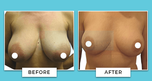 Breast Reduction Before And After