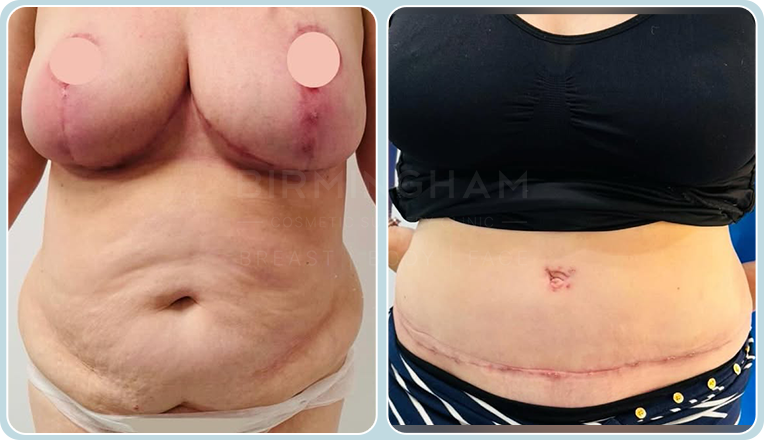 breast reduction, full tummy tuck and vaser liposuction