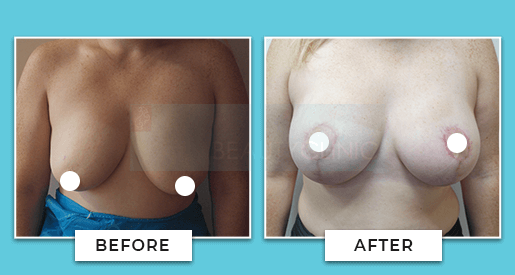 Breast Uplift Before And After