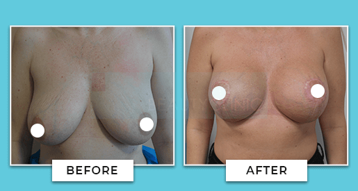 Breast Uplift Before And After