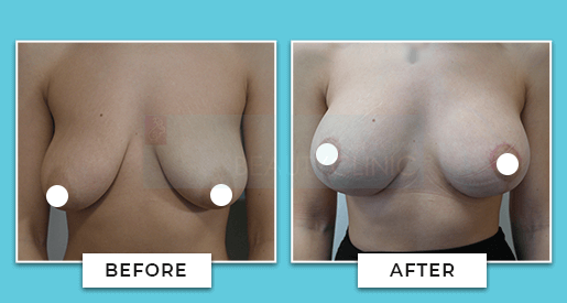 Breast Uplift Before And After