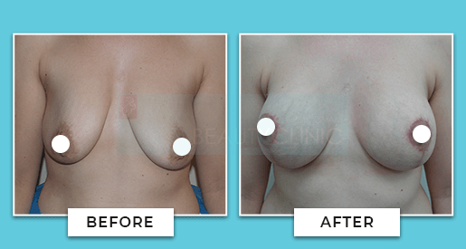 Breast Uplift Before And After