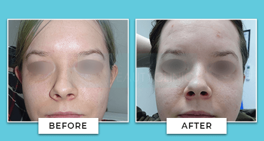 Ear Correction Before And After