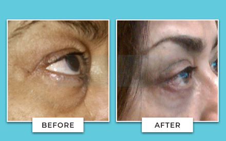 Eyelid Surgery Before And After
