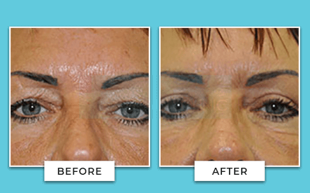 Eyelid Surgery Before And After