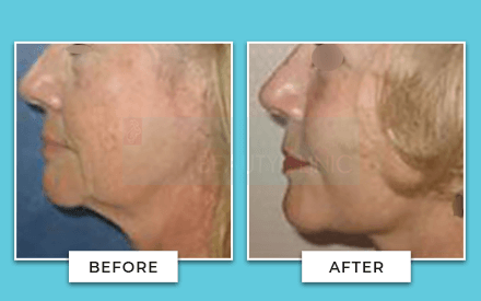Facelift Before And After