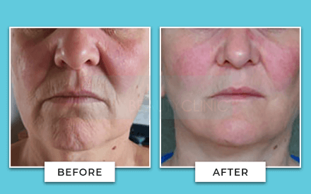 Facelift Before And After
