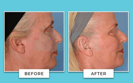 Facelift Before And After