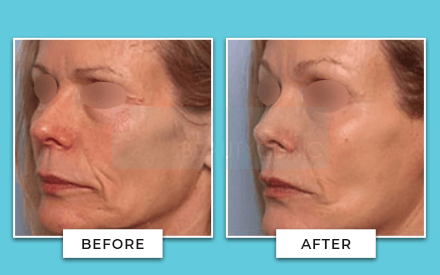 Facelift Before And After