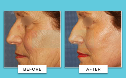 Facelift Before And After