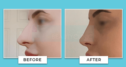 nose job before and after