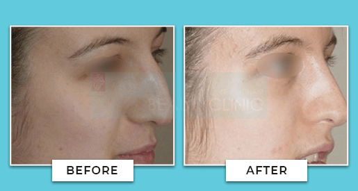 nose job before and after