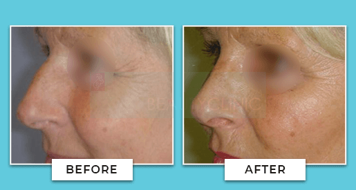 nose surgery before and after 2