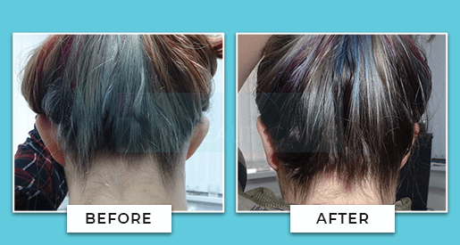 Ear Correction Before And After