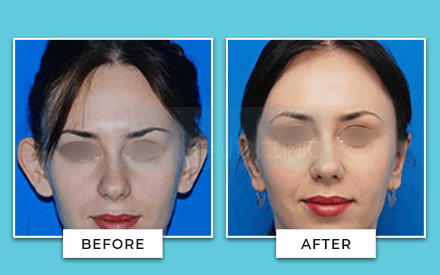 Pinnaplasty Before And After