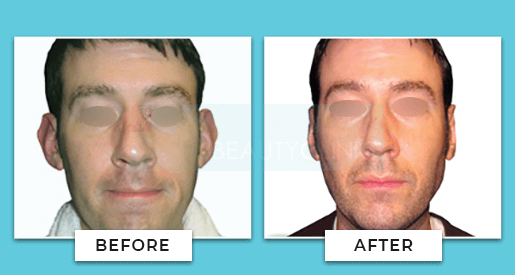 Pinaplasty Before And After