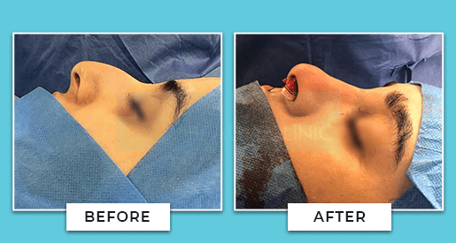 rhinoplasty before and after 1