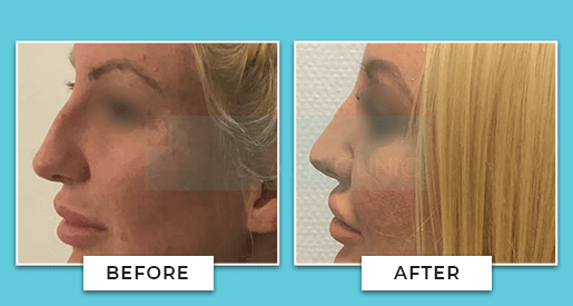 rhinoplasty before and after 2