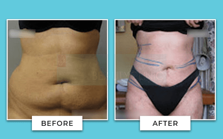 Tummy Tuck Before And After