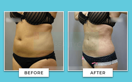 Tummy Tuck Before And After