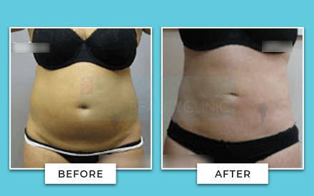 Tummy Tuck Before And After