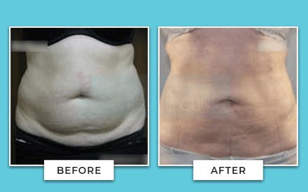 Tummy Tuck Before And After