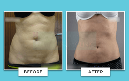 Tummy Tuck Before And After