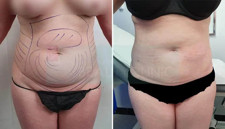Vaser Lipo Before And After Stomach