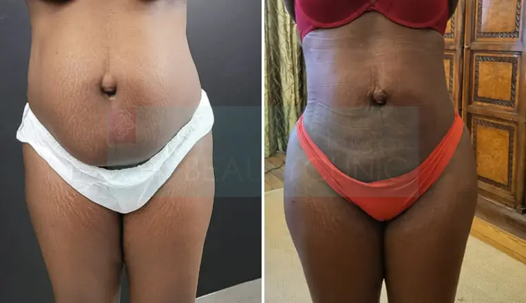 Vaser Lipo Before And After Stomach