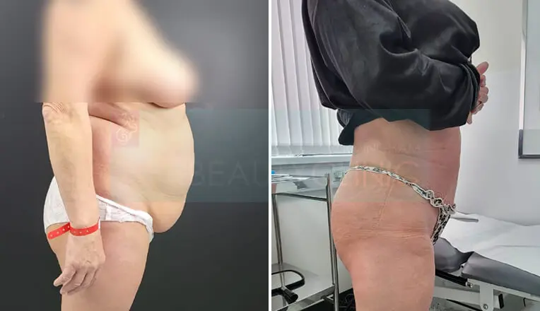 Vaser Liposuction Before And After