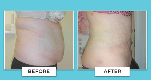 Vaser Liposuction Before And After