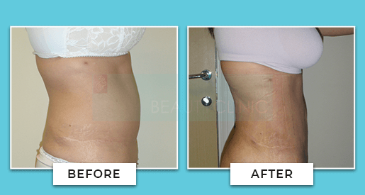 Vaser Liposuction Before And After