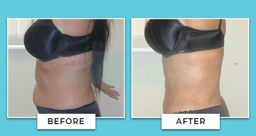 Vaser Liposuction Before And After